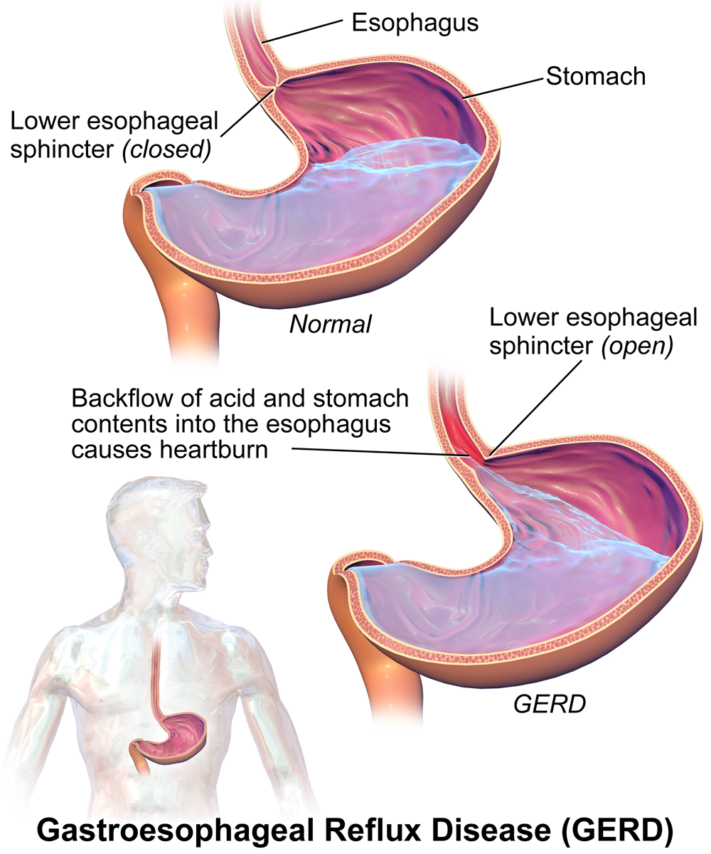How stomach acid refluxes up into the esophagus in GERD — Wikimedia Commons (CC BY-SA 4.0)