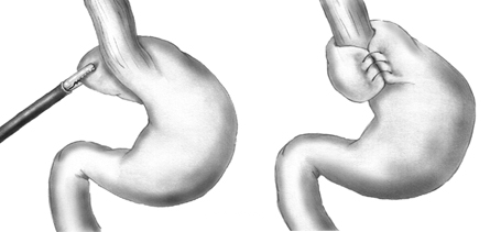 Fundoplication surgery reinforces the valve between stomach and esophagus — Wikimedia Commons (public domain)