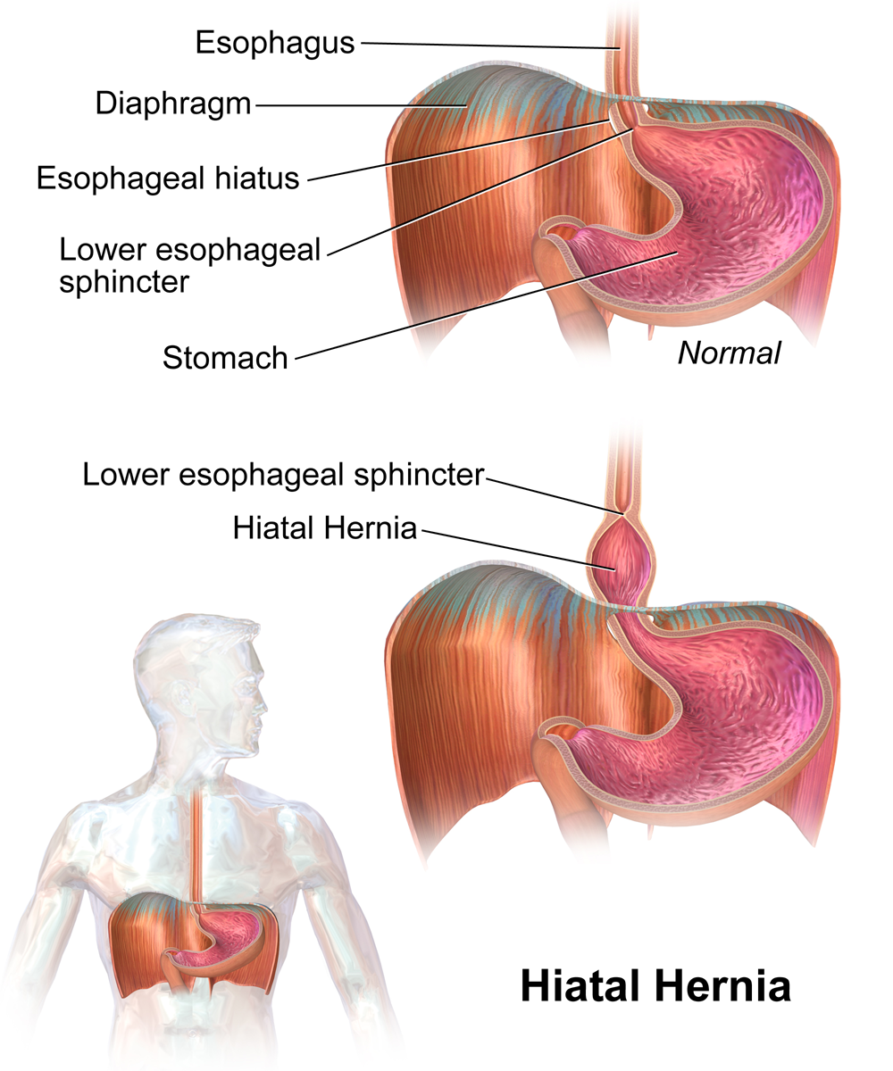 A hiatal hernia, which can worsen reflux by weakening the valve — Wikimedia Commons (CC BY-SA 4.0)
