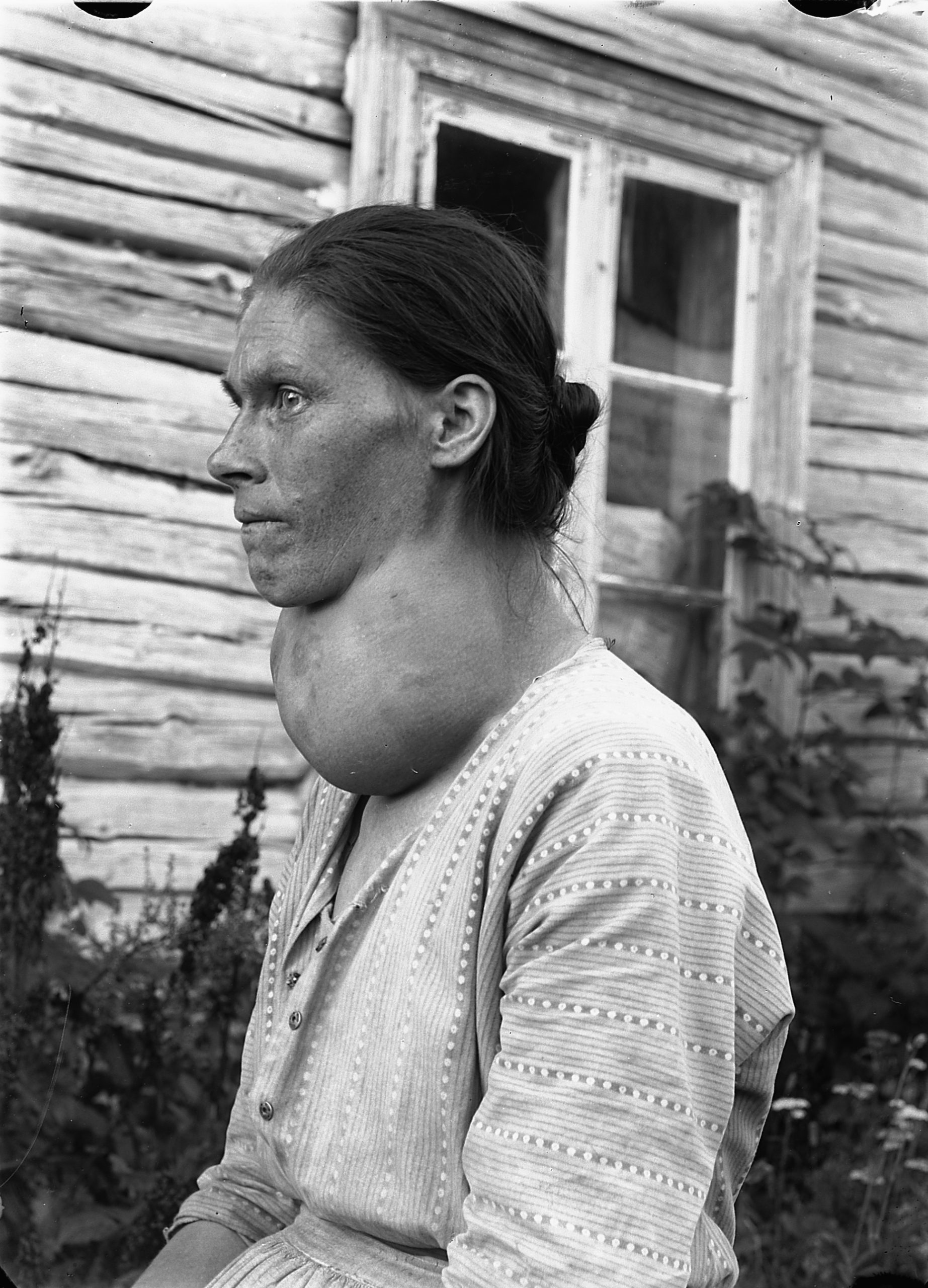 An enlarged thyroid, or goiter, which can accompany thyroid disease — Wikimedia Commons (public domain)