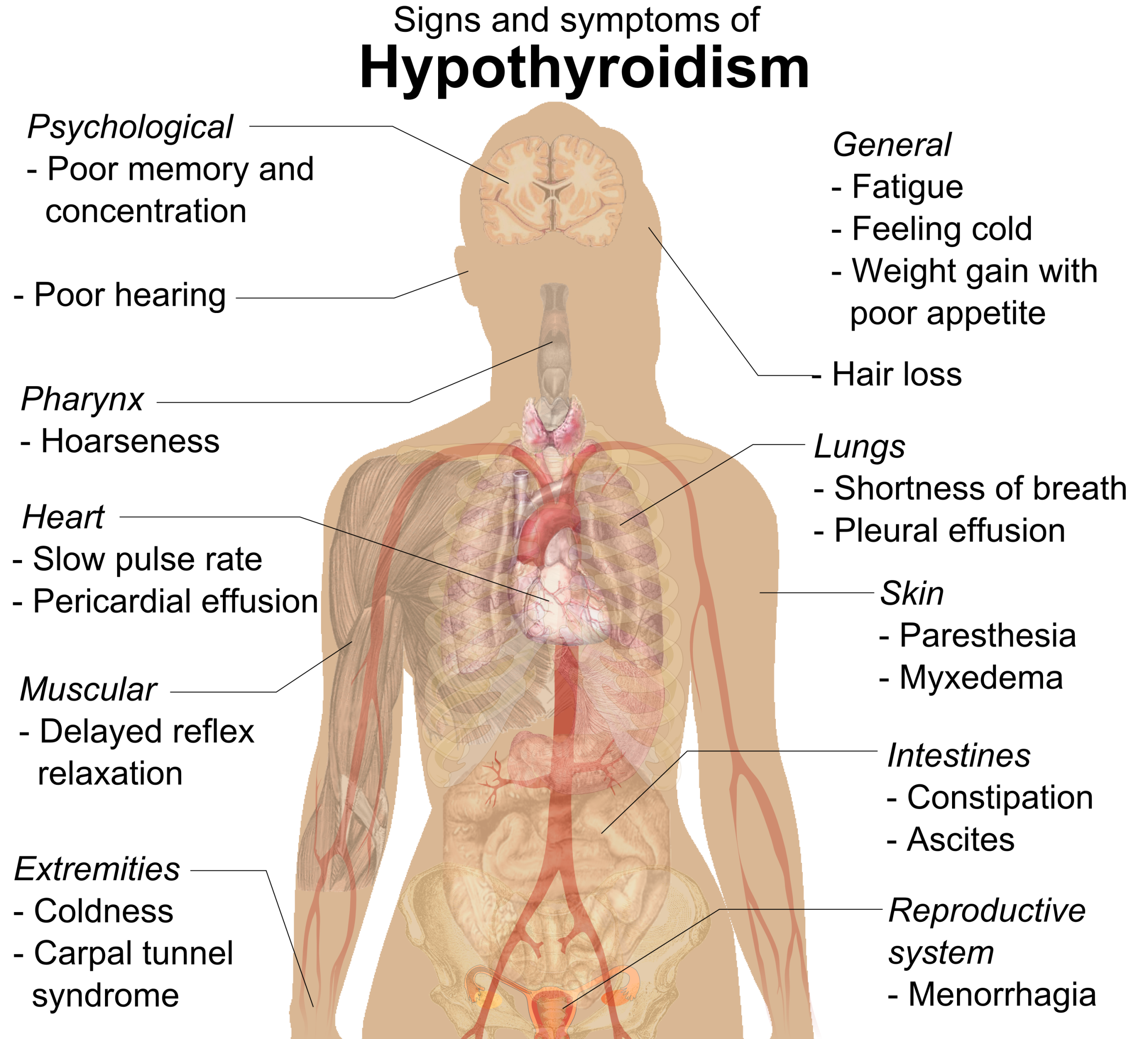 Common signs and symptoms of hypothyroidism — Wikimedia Commons (CC0)
