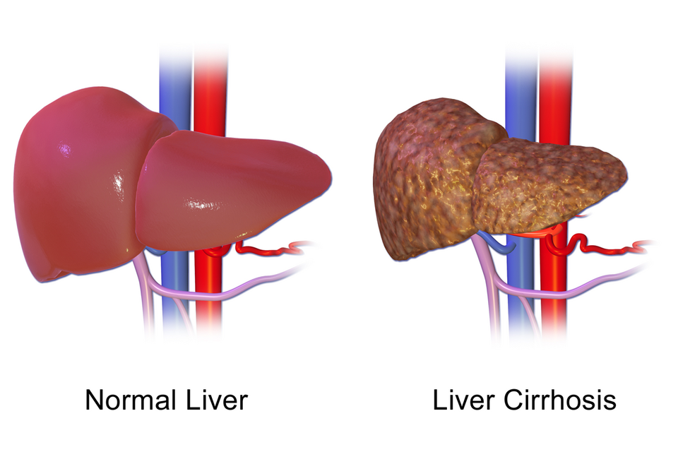 Progression of liver scarring toward cirrhosis — Wikimedia Commons (BruceBlaus, CC BY-SA 4.0)