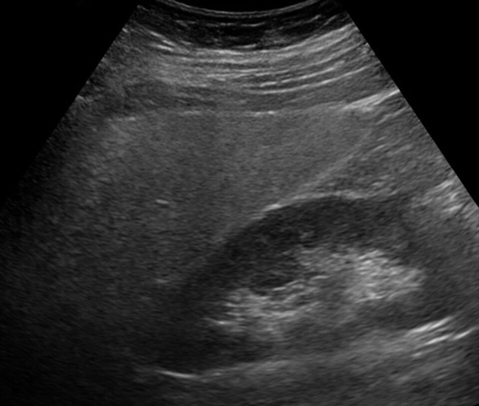 Ultrasound image of a fatty (bright) liver — Wikimedia Commons (Hellerhoff, CC BY-SA 3.0)