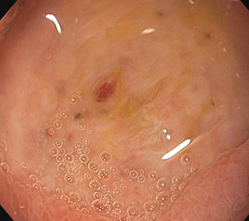 A duodenal ulcer seen during endoscopy — Wikimedia Commons (CC BY-SA 3.0)