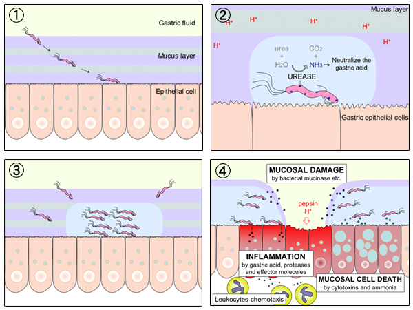 How H. pylori and acid combine to form a peptic ulcer — Wikimedia Commons (CC BY-SA 3.0)